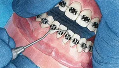 Pulizia dentale su apparecchio ortodontico con strumento professionale