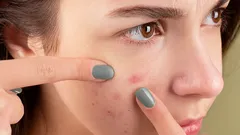 Come dimenticare per sempre brufoli e cicatrici: metodi sicuri ed efficaci